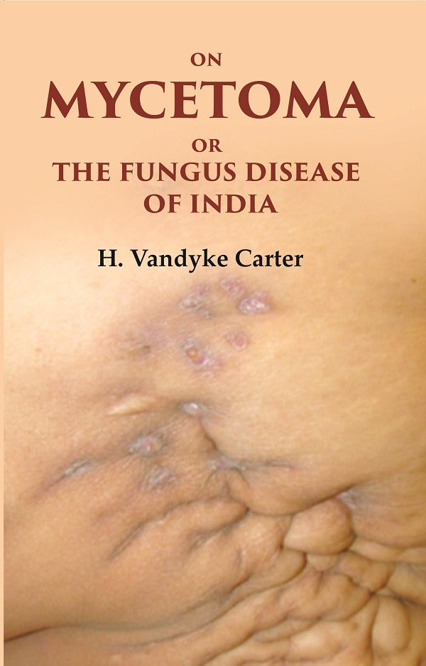 On Mycetoma or the Fungus Disease of India